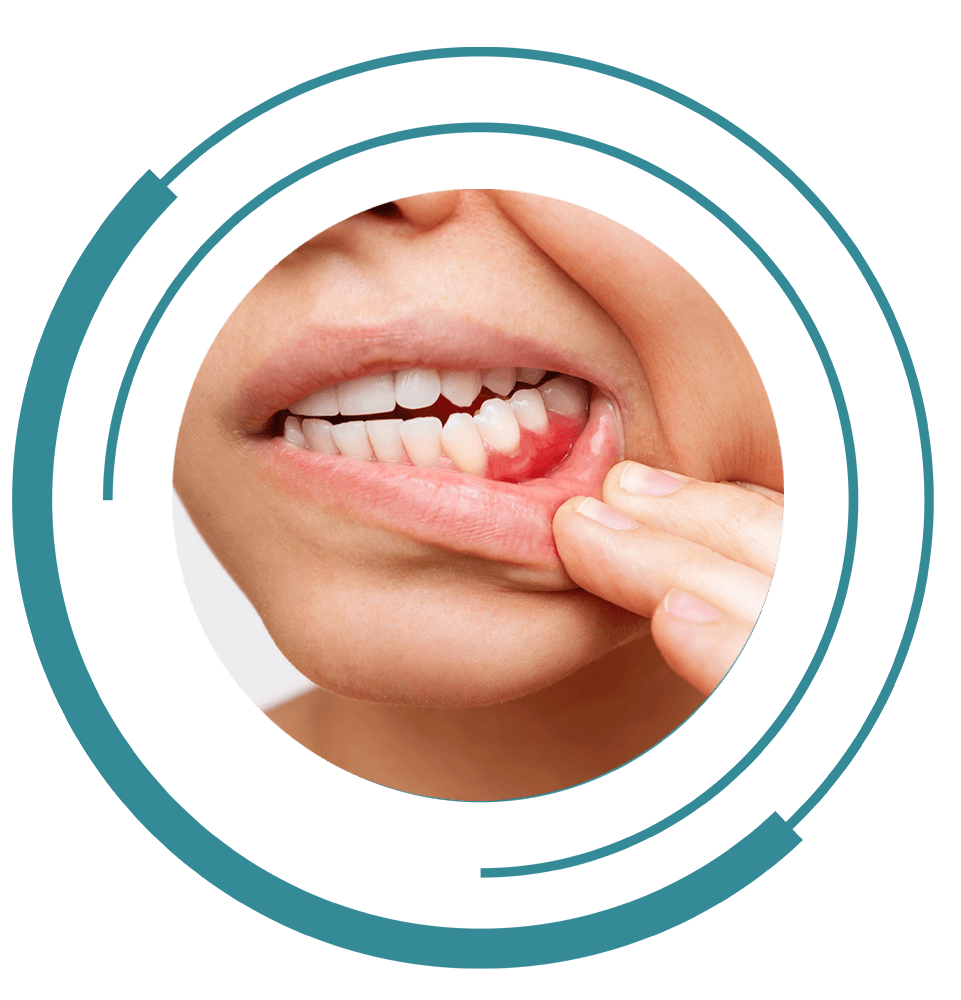 gum disease