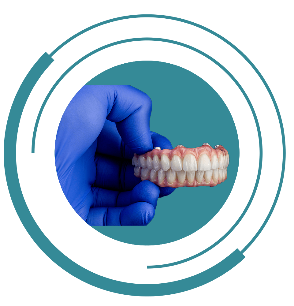 full mouth implants